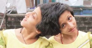 twins Saba and Farah, Bihar's conjoined twins happy over apex court ruling
